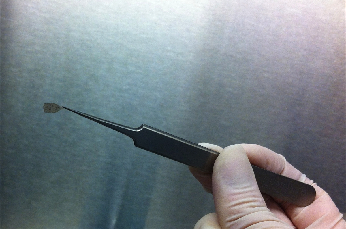 RPT's Stem Cell Implant: A Growth Signal in the Fight for Sight