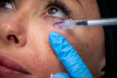 The Micro-Needle Revolution: How Tiny Silicon Spikes Are Going Global