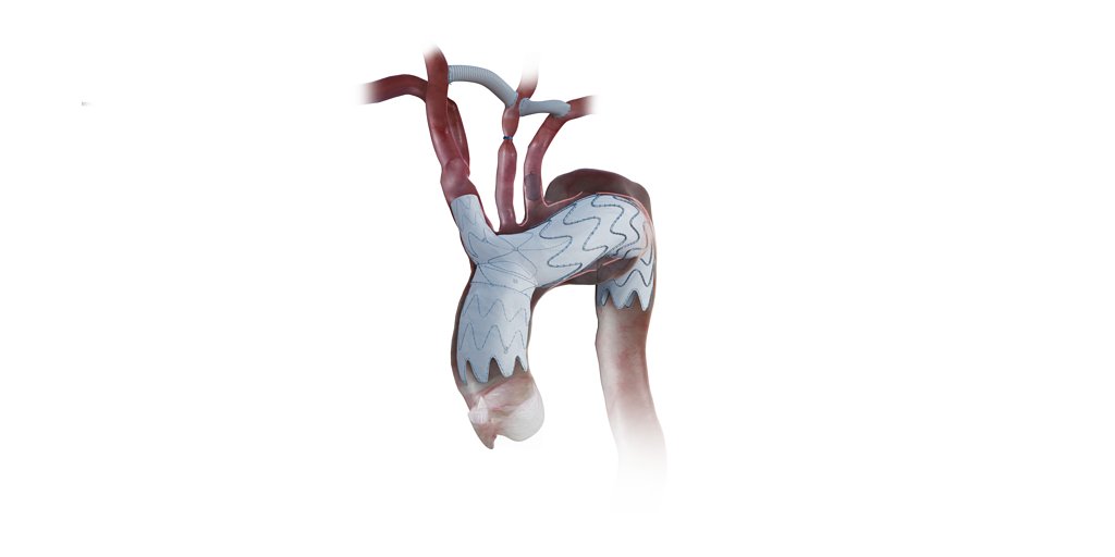 Endospan's NEXUS Stent Wins FDA Nod for High-Risk Aortic Repair