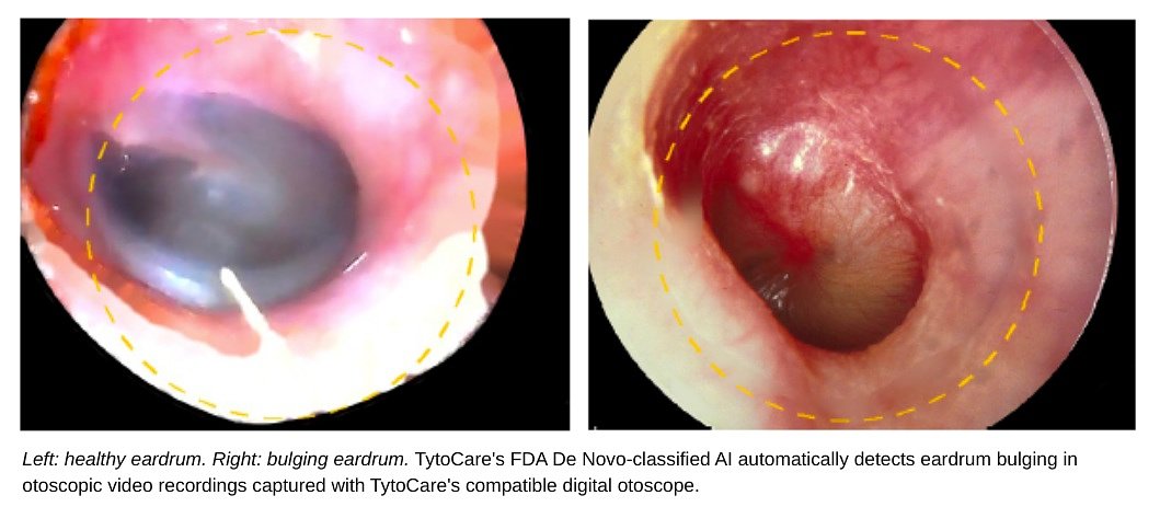 FDA Clears First AI to Diagnose Ear Infections From Home