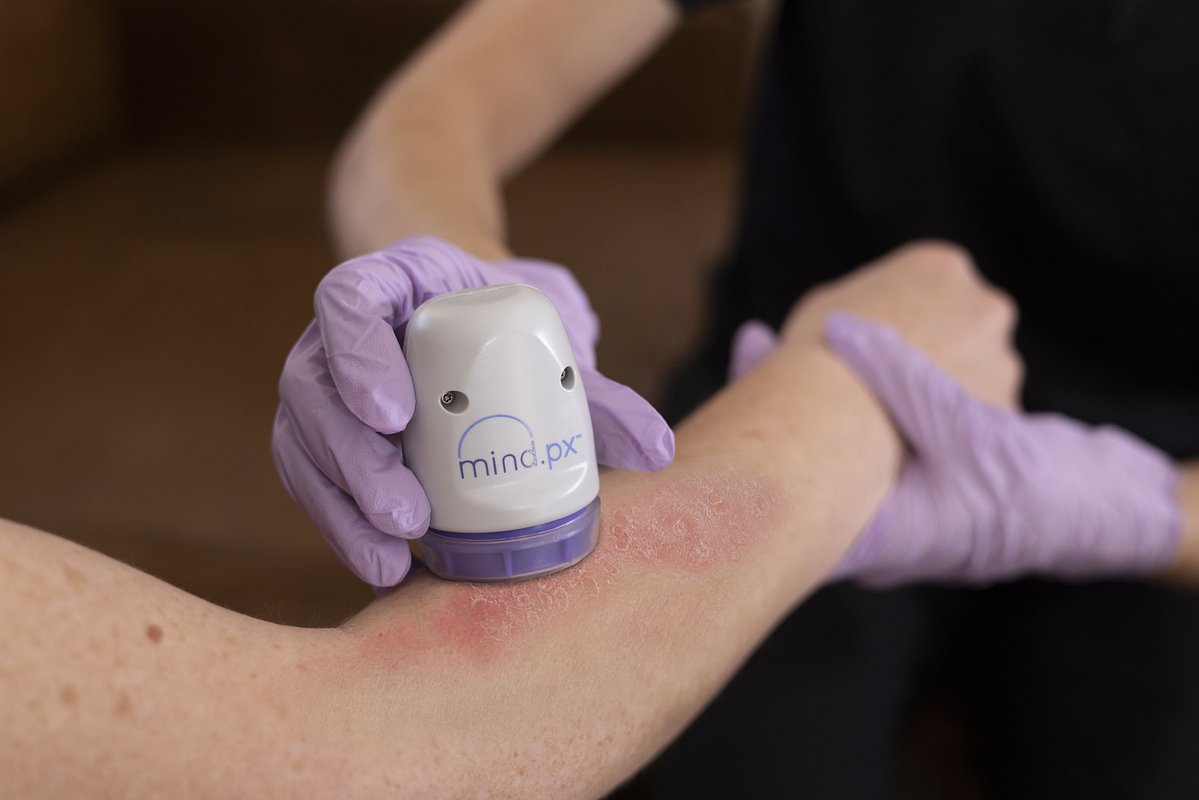 NY Approves AI Psoriasis Test, Unlocking Nationwide Precision Care