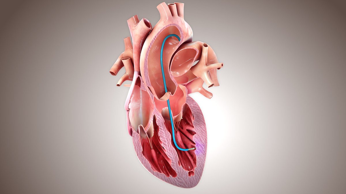 BioCardia Advances Key Device for Precision Heart Treatment