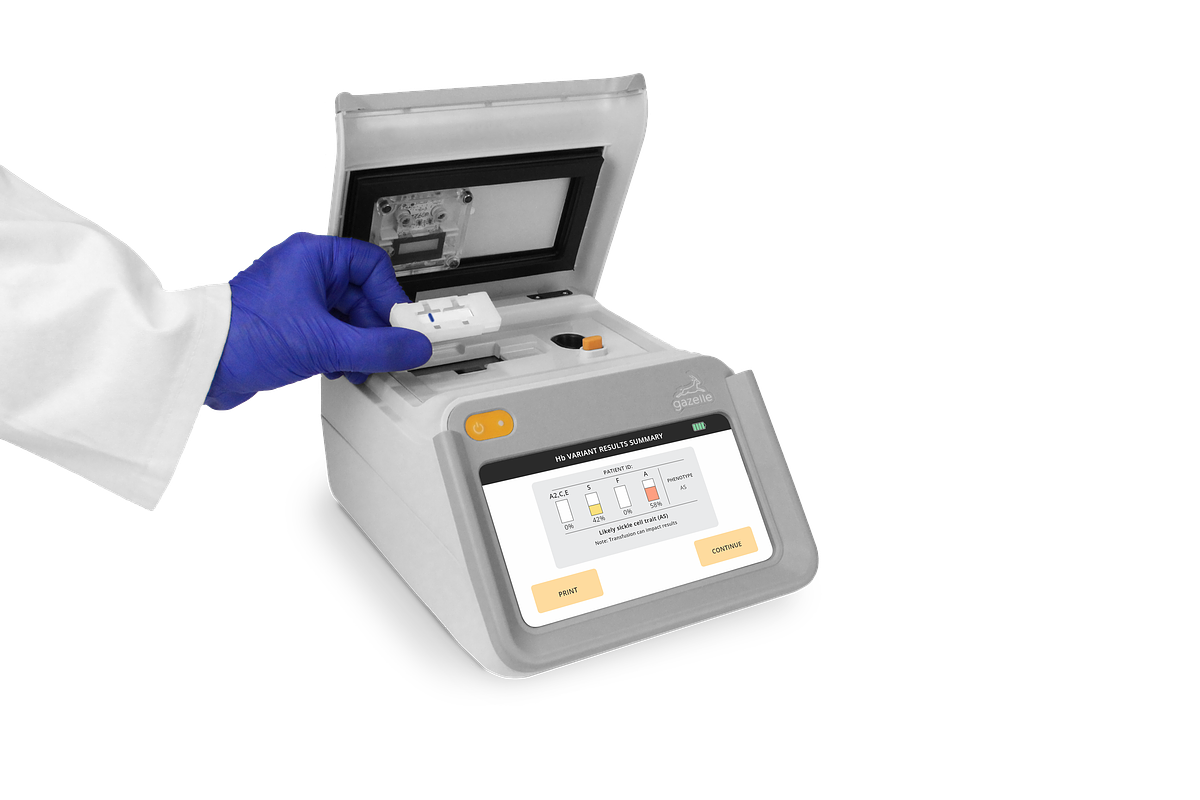 FDA Fast-Tracks Sickle Cell Test, Boosting Global Health Equity