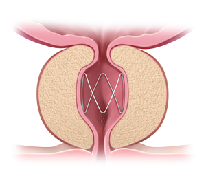 ProVerum's Gentle BPH Stent: A New Challenger in a $12B Market