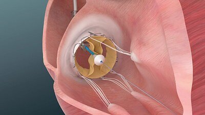 New Heart Valve Shows Promise for Untreated Tricuspid Regurgitation