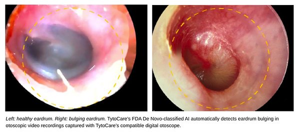 FDA Clears First AI to Diagnose Ear Infections From Home