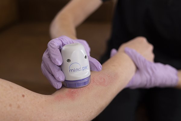 NY Approves AI Psoriasis Test, Unlocking Nationwide Precision Care