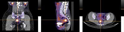 Endometriosis Breakthrough: New Scan Promises to End Diagnostic Limbo