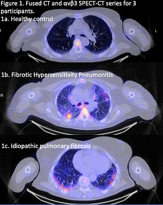 FDA Fast-Tracks Novel Imaging Agent for Lung Disease Diagnosis