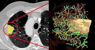 AI Tool Reads Tumors to Predict Lung Cancer Treatment Success