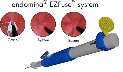 FDA Clears ETT's EZFuse System to Speed Up Endoscopic Surgery
